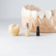 Etapas de um implante dentário (1)