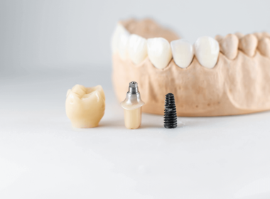 Etapas de um implante dentário (1)