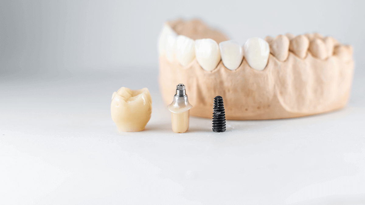 Etapas de um implante dentário (1)