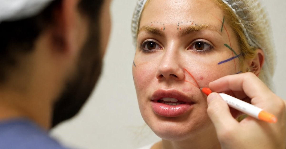 Janaína Santucci celebra pós-operatório tranquilo após lifting facial endoscópico com Dr. Bruno Alberton